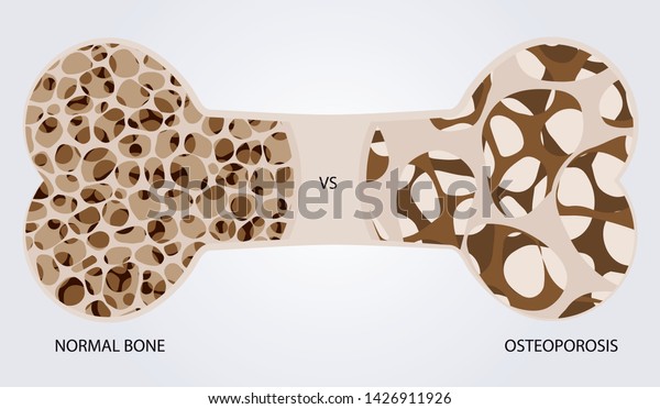 Bone Osteoporosis Normal Bone Versus Osteoporosis Stock Vector (Royalty ...