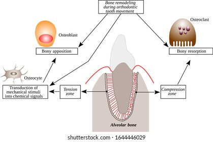 Bone remodeling during orthodontic tooth movement. Vector illustration