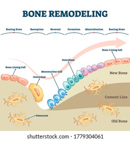 Bone remodeling process educational explanation with labeled structure scheme vector illustration. Skeleton growth closeup and formation stages with osteocyte, osteoclast or osteoblast example diagram