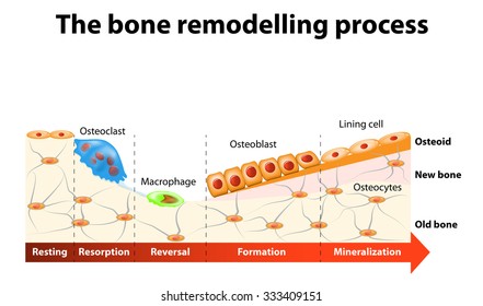 The bone remodeling process involves the following steps: resorption, reversal, formation, mineralization and resting. In a healthy body, osteoclasts and osteoblasts work together