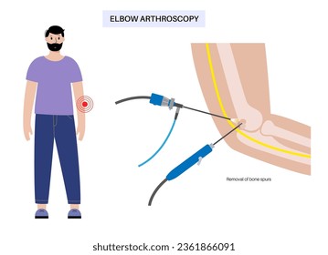 Knochen bewirken die Entfernung. Ellengelenk minimal-invasive Chirurgie. Arthroscopy medizinisches Verfahren. Anatomie von Humerus-, Ulna- und Radiusknochen. Armschmerzen, Schwellungen und Entzündungen, RöntgenVektorgrafik