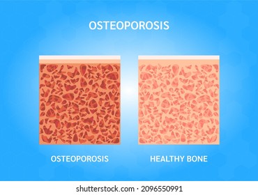 Bone structure normal and osteoporosis. Medical check up health concept. Vector EPS10 illustration.