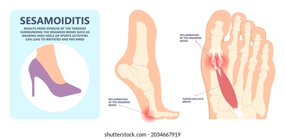 Inflamación de las cápsulas de los dedos de los pies de los ligamentos