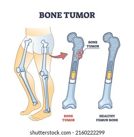 Tumor óseo como crecimiento del tejido abdominal en el diagrama esquelético humano. Esquema educativo etiquetado con condición médica y huesos de fémur sano comparando ilustraciones vectoriales. Problema ortopédico.