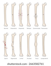 Ossos com diferentes tipos de fraturas. Ilustração de vetor médico. 