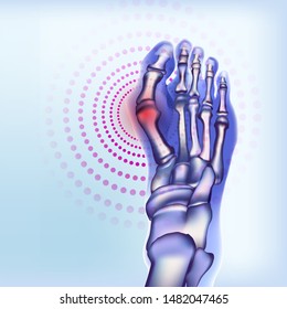 Bones of foot with rheumatoid arthritis