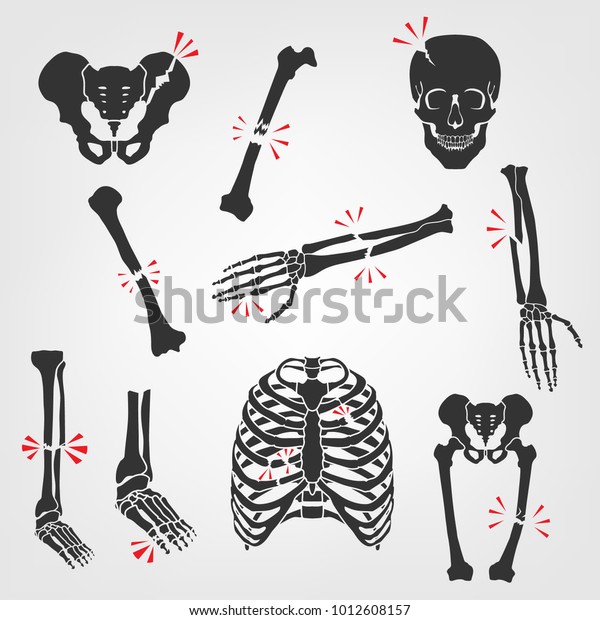 Bones Fractures Icons. Flat vector\
illustrations isolated on a white background. Broken skull, ribs,\
thigh, foot, pelvis, femur, hand palm,\
etc