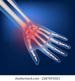 Bones of a human hand on a blue background. Inflammation of the joints. Medical poster. Vector illustration