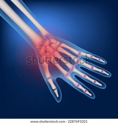 Bones of a human hand on a blue background. Inflammation of the joints. Medical poster. Vector illustration