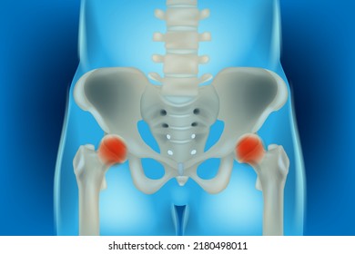 Bones of the pelvis and hip, human anatomy, femur bone joint pain, X ray of the hip joint and femur. Osteonecrosis of the Hip.  3d illustration