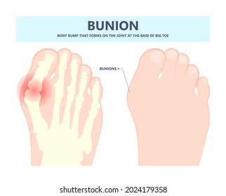 bony bump joint big toe bone enlarge fifth foot pain shoe Tailor swollen feet wearing poor fitting high heel Inversion lump bursa Hammer bend tendon stress injury gout spur callus corn turf flat feet