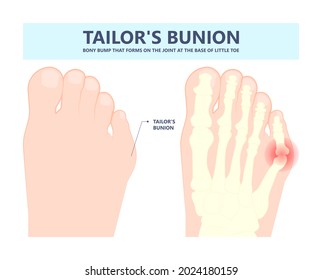 bony bump joint big toe bone enlarge fifth foot pain shoe Tailor swollen feet wearing poor fitting high heel Inversion lump bursa Hammer bend tendon stress injury gout spur callus corn turf flat feet