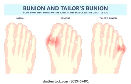 bony bump joint big toe bone enlarge fifth foot pain shoe Tailor swollen feet wearing poor fitting high heel Inversion lump bursa Hammer bend tendon stress injury gout spur callus corn turf flat feet