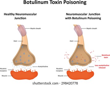 Botulinum Toxin Poisoning