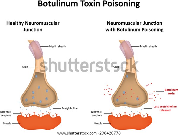 Clostridium Botulinum Toxin Poisation Stock Vektorgrafik