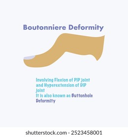 Deformidade de Bouttoniere em vetor de reumatologia