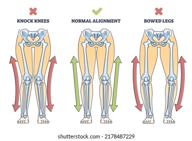 Beinverschluss-Syndrom mit Normal- und Knickschenkelvergleich-Rahmendiagramm. Der mit einem äußeren Biegen und Knie gekennzeichnete körperliche Defekt berührt nicht die Vektorgrafik. Anatomische Erklärung