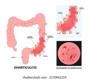 Bowel Colon Cancer And Crohn's Disease Polyp Hernia Rectum Diverticula Ulcer Blood Stool Pain Fecal Exam Sigmoid Diet Blocked Test C. Diff Stoma Swelling Disorder Peritonitis Rectal