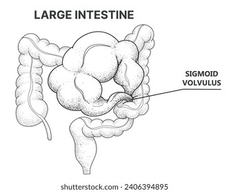 Bowel obstruction. Sigmoid volvulus. Line art drawing. Healthcare illustration. Vector illustration. 