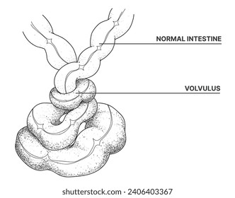 Darmverschluss. Volvulus. Linienzeichnung. Illustration im Gesundheitswesen. Vektorgrafik. 