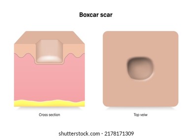 Boxcar scar. Facial skin problems. Vector for advertising about beauty and medical treatment.