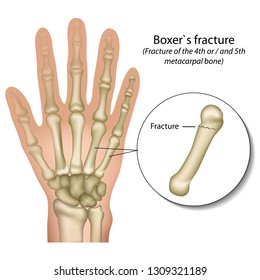 Boxer`s bone hand fracture medical vector illustration