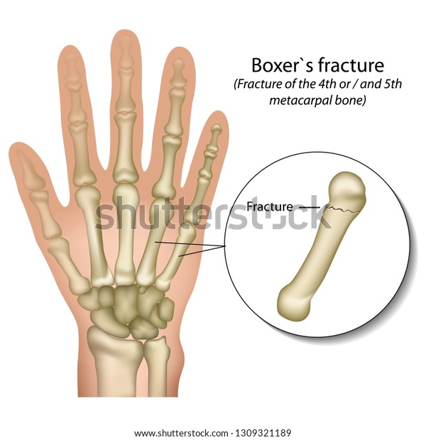 Boxer`s\
bone hand fracture medical vector\
illustration