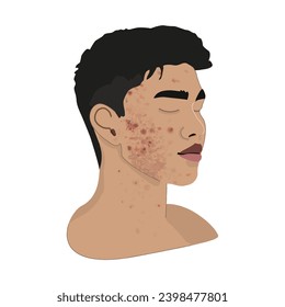 Boy Asian teen acne breakout scars cheek black hair closed eyes skin realistic body diversity isolated head vector illustration flat art icon dermatology face care natural beauty model representation 