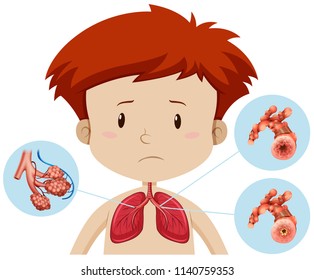 A boy with bronchitis illustration