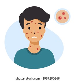 Boy with chickenpox symptoms. Skin rashes and pimples. Vector character in  flat style.