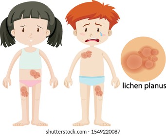 Boy and girl with lichen planus illustration