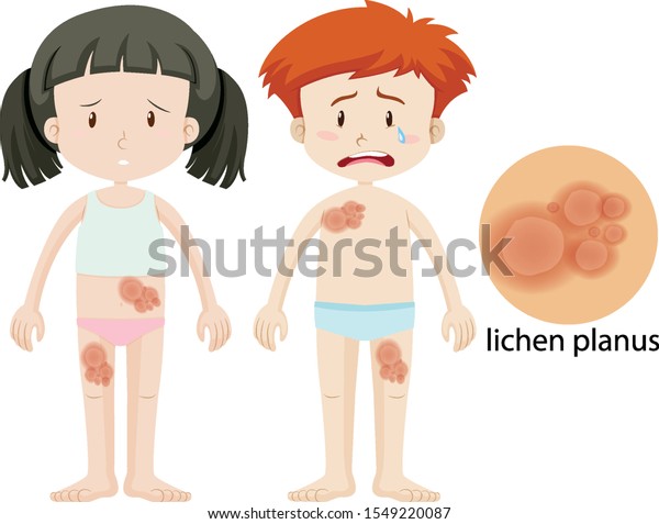 Boy Girl Lichen Planus Illustration Stock Vector (Royalty Free) 1549220087