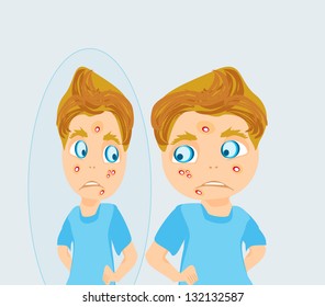 boy in puberty with acne
