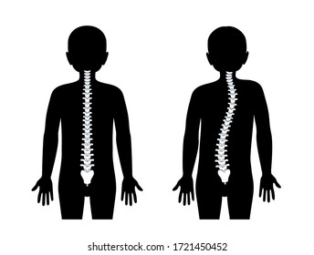 Boy scoliosis flat vector illustration. Types of scoliosis of spine infographics. Diagram with spine curvatures. Body posture defect. Medical, educational and science banner