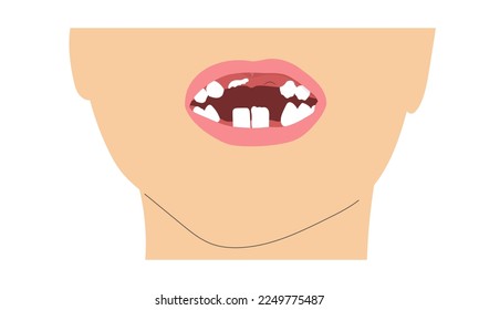 A boy smile missing tooth due to change of milk teeth. Simple minimalistic illustration of baby mouth with incomplete set of teeth.