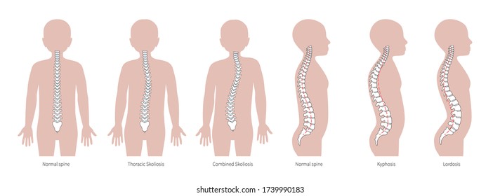 Boy spinal deformity flat vector illustration. Kyphosis, lordosis and scoliosis of spine infographics.. Body posture defect. Medical, educational and science banner.