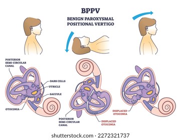 BPPV or benign paroxysmal positional vertigo syndrome outline diagram. Labeled educational medical scheme with spinning and dizziness sensation cause vector illustration. Ear canal disease anatomy.