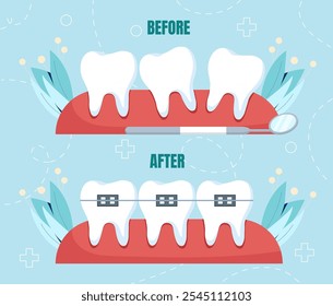 Brace teeth correction. Teeth before and after. Healthcare and medicine, treatment. Orthopedic equipment for correcting bite. Flat vector illustration isolated on white background