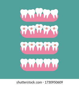 Braces antes, después, de la ortodoncia para la clínica dental, antes y después. Ilustración vectorial plana.