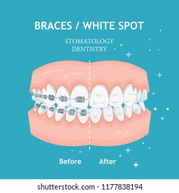 Braces concept. White spots. Stomatology dentistry vector