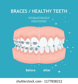 Braces Concept. White Spots. Stomatology Dentistry Vector