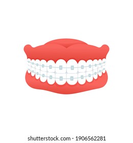 Braces for correction  jaw and teeth, isolated on white background. Concept dental medecine. Cartoon flat design. Vector illustration.