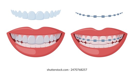 Ortodoncia correctiva, boca femenina sonriente con dientes y aparatos ortopédicos sanos. Dientes con tirantes transparentes. Alineación de dientes por alineadores. Alineador de llaves invisibles, retenedor. Vector