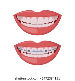 Braces Corrective Orthodontics, smiling female mouth with healthy teeth and braces. Healthy smile. Dentistry, dental treatment, orthodontics. Vector