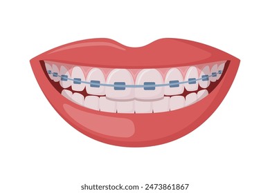 Braces Corrective Orthodontics, smiling female mouth with healthy teeth and braces. Dentistry, dental treatment, orthodontics. Vector