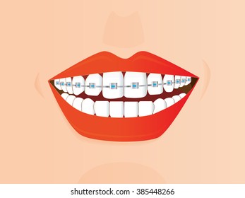 Braces corrective, smiling female mouth with healthy teeth and braces. 