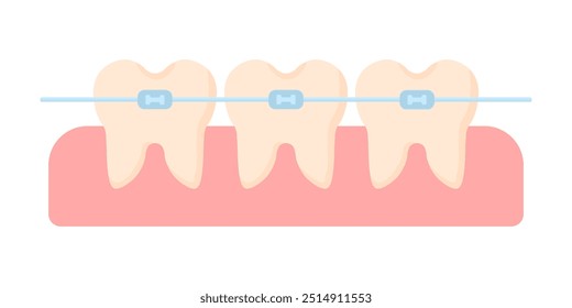 Braces are installed on the teeth in cartoon style on a white isolated background. Braces on healthy teeth. Dental treatment. Malocclusion