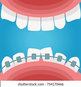 Braces in the mouth. Vector. Cartoon. Isolated art. Flat