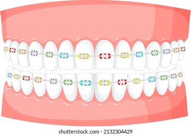 Braces on a model of human teeth on white background illustration