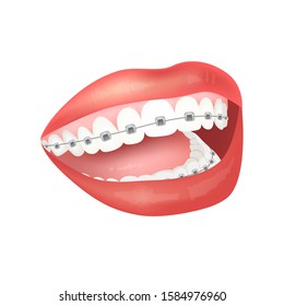 Braces on the teeth. Beautiful smile with braces. Open mouth with teeth isolated on a white background. Vector stock illustration for dental clinic.